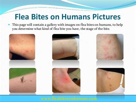 Flea Bites Vs Scabies Home
