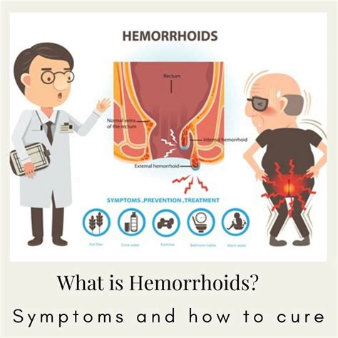 External Hemorrhoids Vs Skin Tags