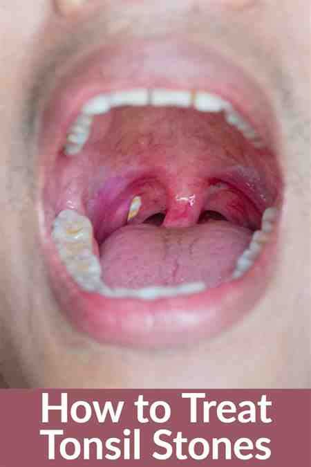 Sore Throat And Tonsils Removed Cause Tonsillitis V Alert Vrtl T Tonsil