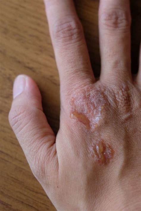 Psoriasis And Hiv What Is The Link