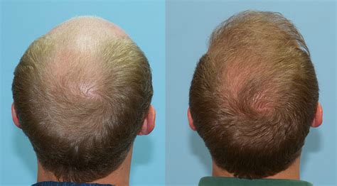 Fue Hair Grafts In Day Transplant Session Carolina Hair Surgery