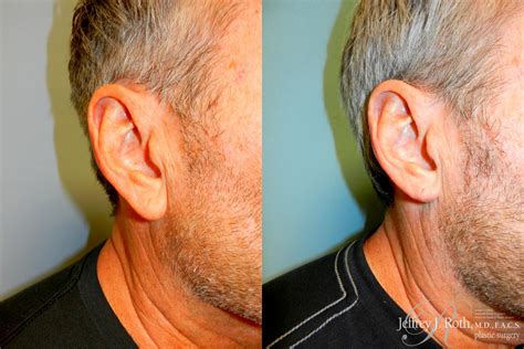 Earlobe Reduction Surgery Before And After Pictures Case 229 Las