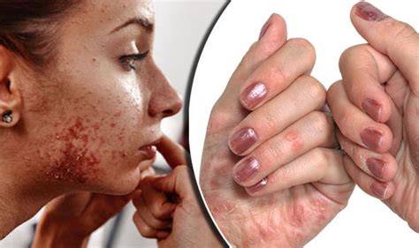 Six In Every Ten Britons Have Suffered From A Skin Condition Such As