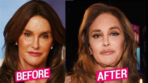 Caitlyn Jenner Unveils Freaky Face Amid Claims Of MORE Surgery