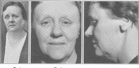 Figure 1 From The Treatment Of Tumours Of The Salivary Glands By