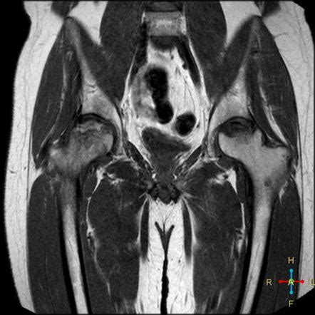 Avascular Necrosis Of The Hip Radiology Reference Article