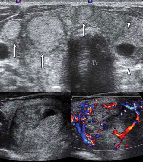 Multinodular Goitre A Transverse Dual Ultrasound Image Shows