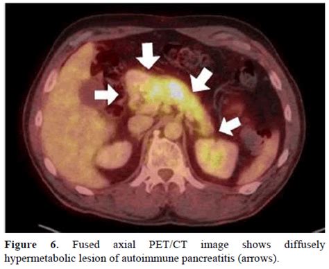 18f Fdg Petct Imaging Of The Pancreas Spectrum Of Diseases