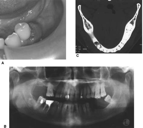 Osteonecrosis Of The Jaw Correlated To Bisphosphonate Therapy In Non