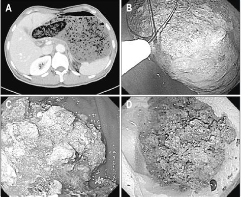 A Detection Of A Gastric Bezoar Of Approximately 6 Cm Accompanied By