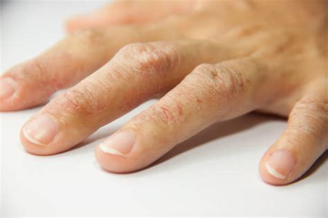 Red Rush Or Eczema On Hand Of Allergic Patient Stock Photos Pictures