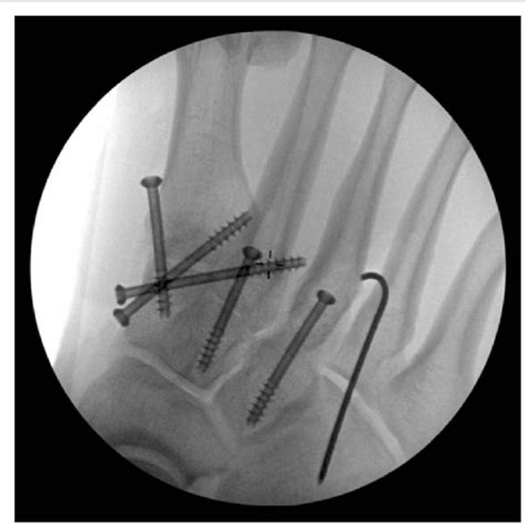 Intraoperative View Of The Screw And K Wire Fixation Of The Tmt Joints