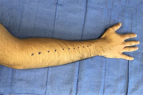 Compartment Syndrome Forearm Hand Surgery Source