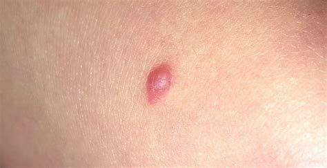 Warts That Lesion Clinician Reviews