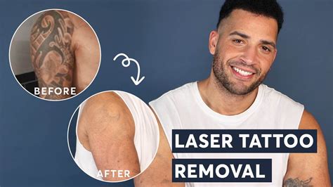 Top 100 Tattoo Removal Before And After Photos