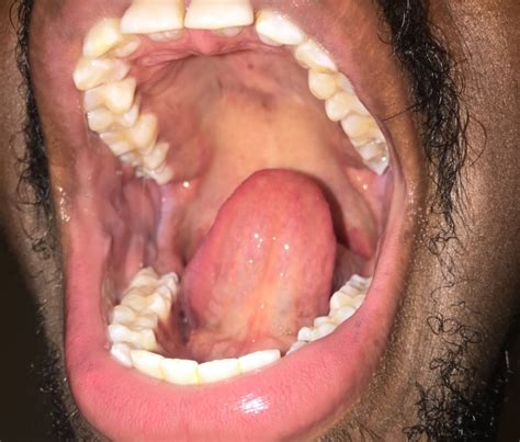 Is This Hpv Oral And Dental Problems Forums Patient
