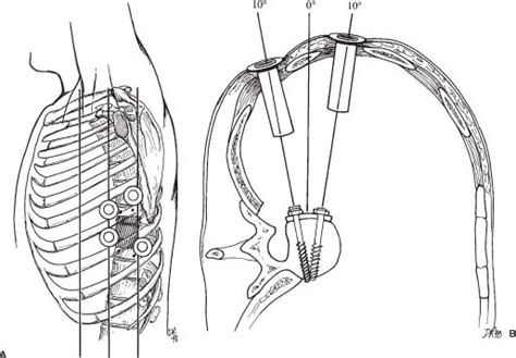 Thoracoscopic Corpectomy And Spinal Reconstruction Neupsy Key
