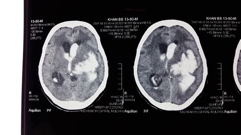 Ct Scan Brain Massive Intracerebral Hemorrhage With Intraventricular