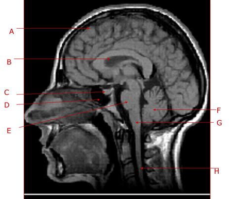 Brain Mri Sagittal Diagram Quizlet