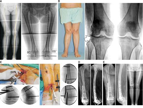 Figure 2 From A Correction Of Malunion Or Deformity In The Lower