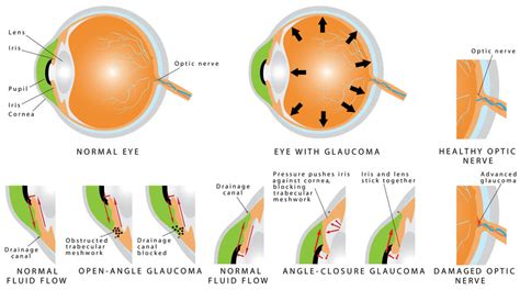 What Are The Types Of Glaucoma Michigan Glaucoma Cataract