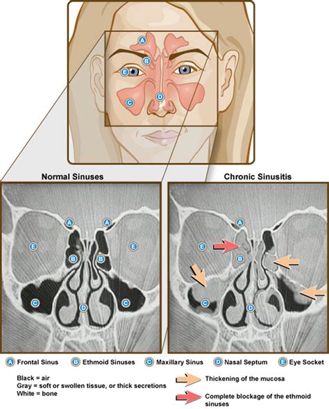 Severe Sinus Infection General Center