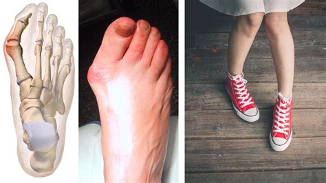 Does Your Shoes Actually Give You Bunions Or Bony Lumps
