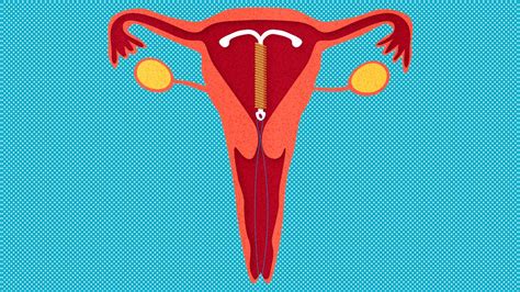 Iuds containing copper can increase menstrual bleeding. Which IUD Is Right for You? Pros and Cons of Different ...