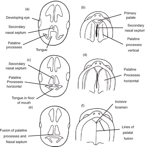 Cleft Palate Anatomy