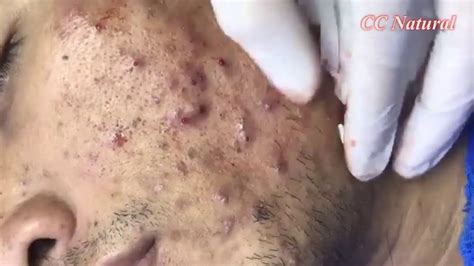 Facial Acne Treatment Blackheads Extraction On Face Acne Removal 5
