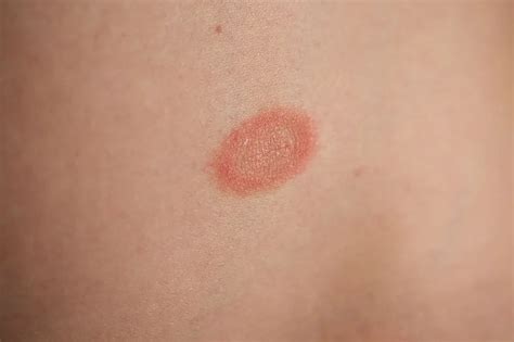 Treating Skin Rash And Inflammation With Healthy Foods Pityriasis Rosea