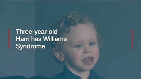 Interesting Facts About Williams Syndrome Symptoms Causes The Best Porn Website