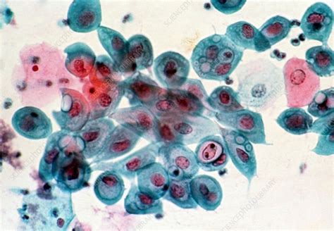 Lm Of Cervical Smear Chlamydia Infection Stock Image M862 0034 Science Photo Library