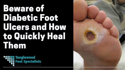 Beware Of Diabetic Foot Ulcers And How To Quickly Heal Them Diabetes