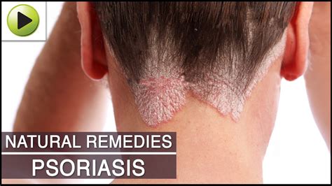 Home Remedies Ayurvedic Treatment For Psoriasis Sickness Dorothee