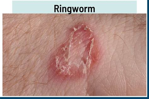 8 Rashes That Look Like Ringworm But Arent With Pictures