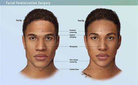 Faq Facial Gender Surgery The Johns Hopkins Center For Transgender
