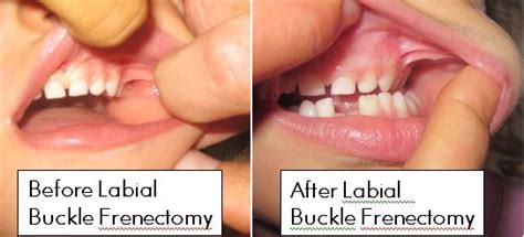 labial frenectomy buckle before after pictures debug your health