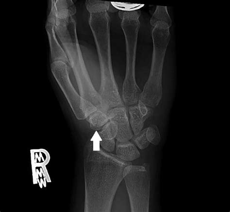 Patient 1 Posterior Anterior Wrist X Ray Shows A Linear Lucency In The