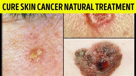 How To Remove A Skin Cancer Cure Skin Cancer Natural Treatment