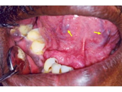 Photos Of Floor Of Mouth Cancer