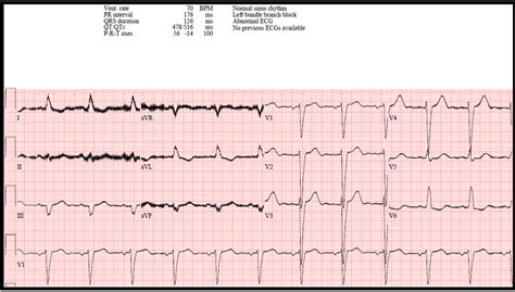 Cureus Probable Hypocalcemia Induced Ventricular Fibrillation And