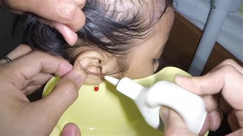Little Girls Earwax Removal Safe Way To Remove Earwax Youtube