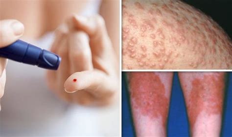 Diabetes Type 2 Symptoms Signs Of High Blood Sugar On Skin And Spots