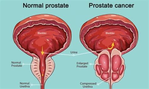 Things Every Guy Should Know About Their Prostate