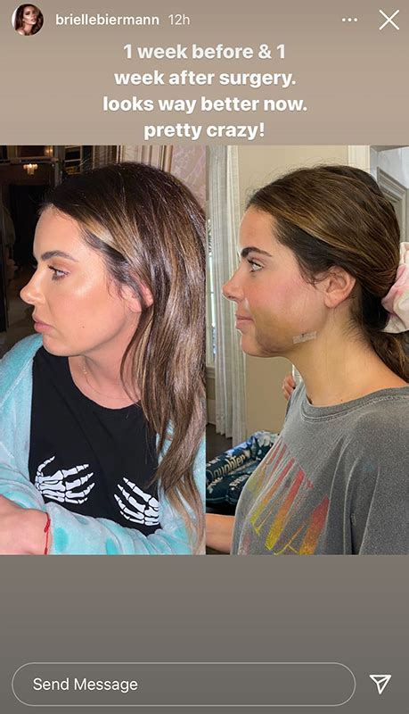 Brielle Biermann S Jaw Surgery Before And After Face Photos Style And Living