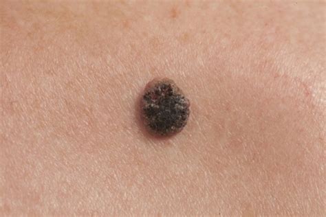10 Deadly Signs Of Skin Cancer You Need To Spot Early Page 6 Health