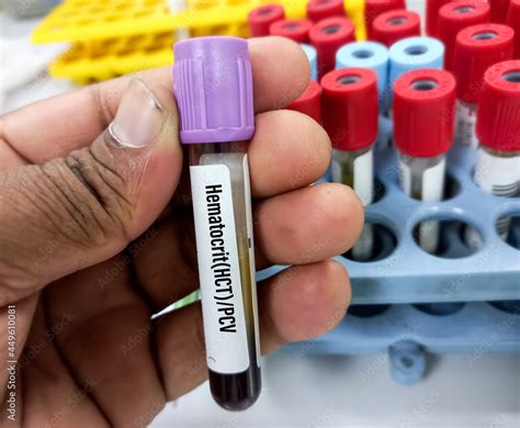 Blood Sample For Hematocrithct Or Packed Cell Volumepcv Test Stock