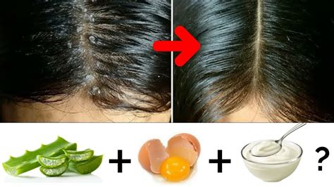How To Remove Dandruff From Hair At Home For Men Best Home Remedy For