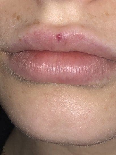 Why Am I Getting Red Spots On My Lips Lipstutorial Org